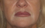 Beryl maquillaje semipermanente labios después (Copy)
